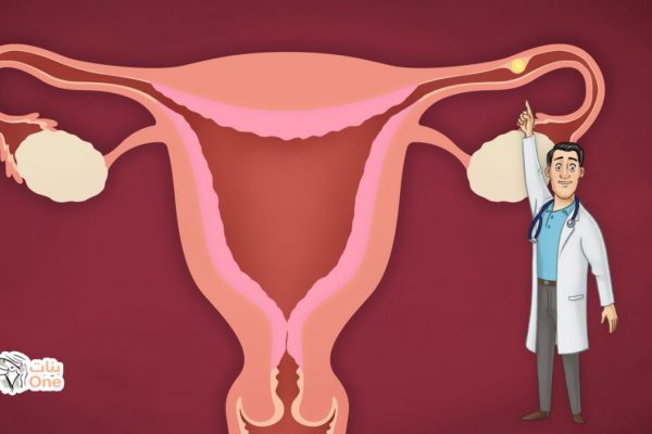 الحمل خارج الرحم.. أسبابه وأعراضه وكيفية التعامل معه  