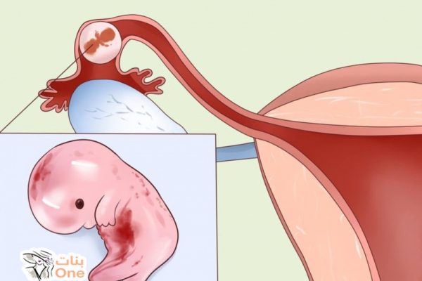 أسباب حدوث حمل خارج الرحم وطرق العلاج المتبعة  