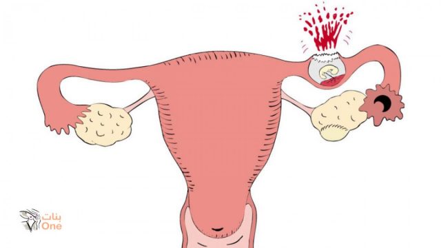 اسباب الحمل خارج الرحم  