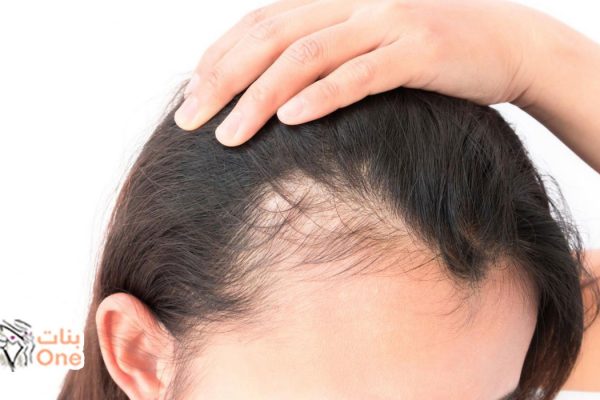 اسباب تساقط الشعر من الامام عند النساء وطرق علاجها  