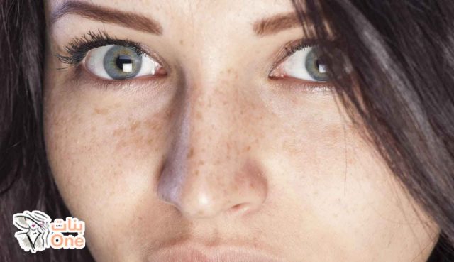 كيفية إزالة البقع البنية من الوجه بالطرق الطبيعية  