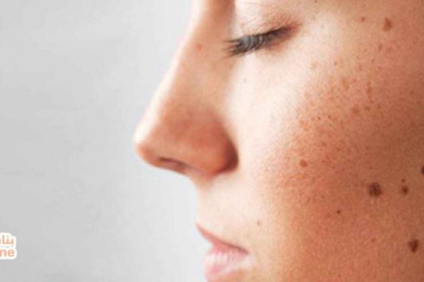 كيفية إزالة البقع البنية من الوجه بالطرق الطبيعية  