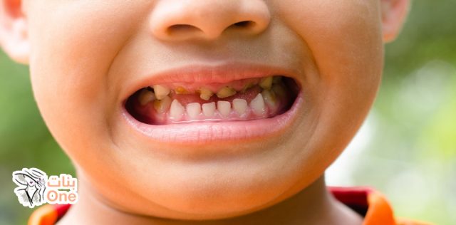 كيف تتجنب تسوس الأسنان في 5 خطوات  
