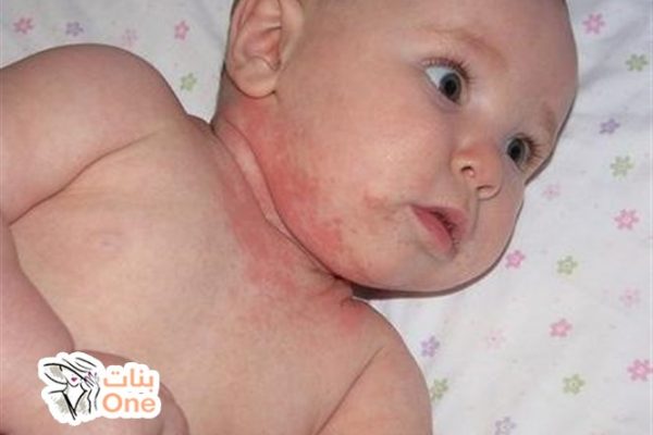 ما أسباب الطفح الجلدي عند الاطفال  