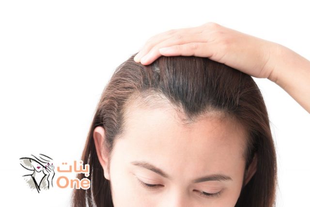 طريقة علاج تساقط الشعر بالثوم خطوة بخطوة  