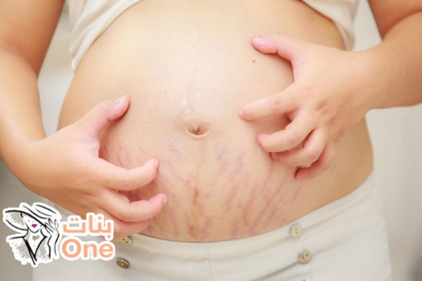 علاج تشققات البطن بعد الولادة بوصفات طبيعية  