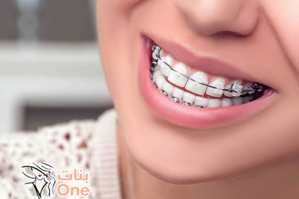 فوائد وأضرار تقويم الأسنان  