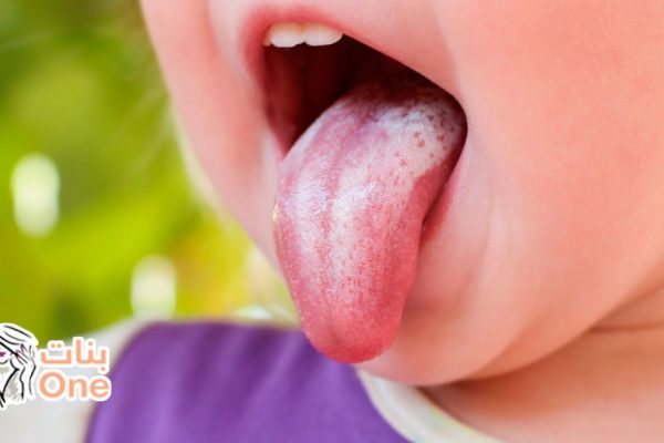 ما هو علاج الفطريات عند الأطفال  