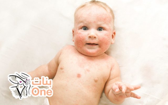 أسباب ظهور حساسية الجلد عند الأطفال  