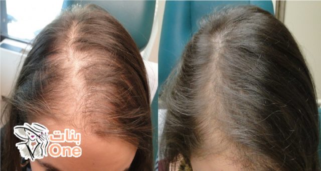 علاج تساقط الشعر الشديد بالوصفات الطبيعية  