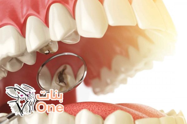 علاج تسوس الأسنان وأسبابه  