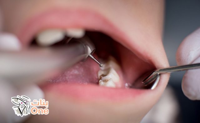 علاج تسوس الأسنان وأسبابه  