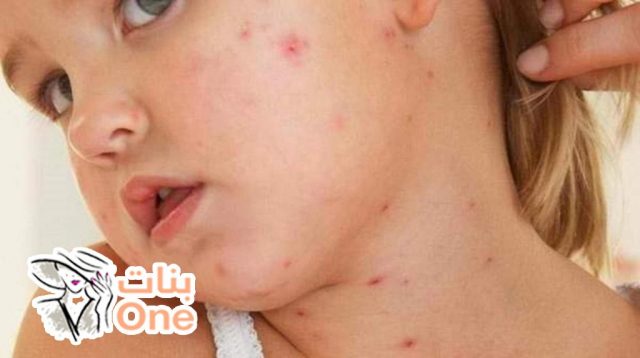 أسباب ظهور بقع حمراء على الجلد عند الأطفال  