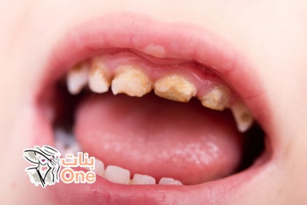 طرق الوقاية من تسوس الأسنان عند الأطفال  