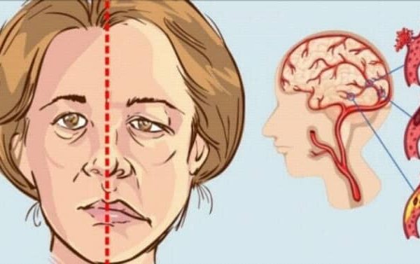 ما هي آثار جلطة الدماغ وأعراضها  