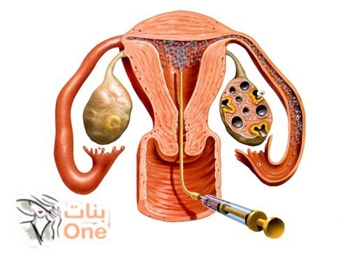 حقن السائل المنوي داخل الرحم  