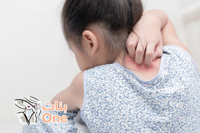 أعراض مرض الصدفية عند الأطفال  