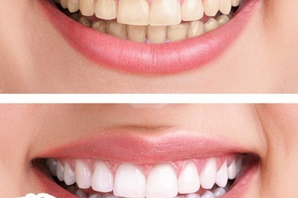 ما هي أنواع تبييض الأسنان  