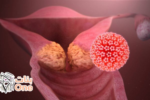 ما هي أمراض عنق الرحم  