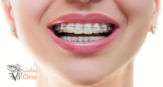 أنواع تقويم الأسنان وأفضلها  