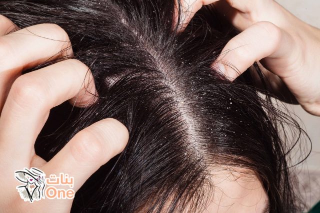 كيفية التخلص من حشرات الشعر  