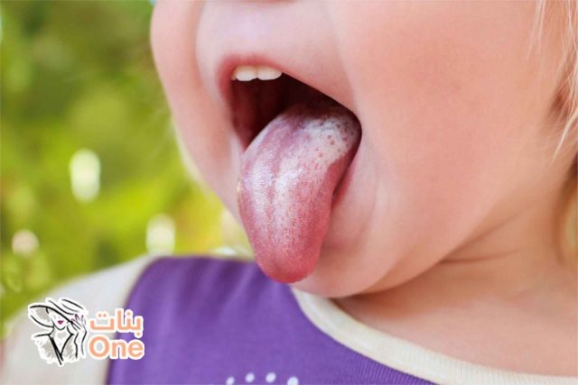 أسباب فطريات الفم عند الأطفال  
