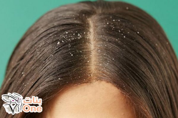 كيفية التخلص من قشرة الشعر نهائياً  