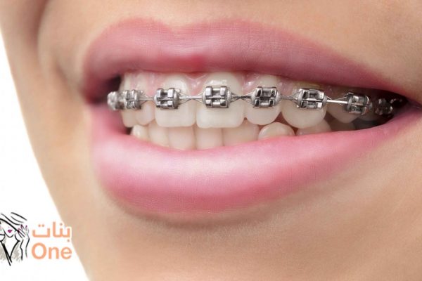 أنواع تقويم الأسنان لتختاري منها ما يناسبك  