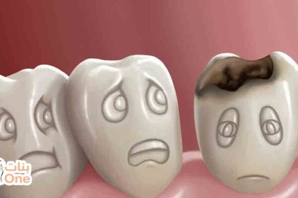 أسباب تسوس الأسنان عند الكبار  