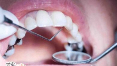 كيف تتخلص من تسوس الأسنان  