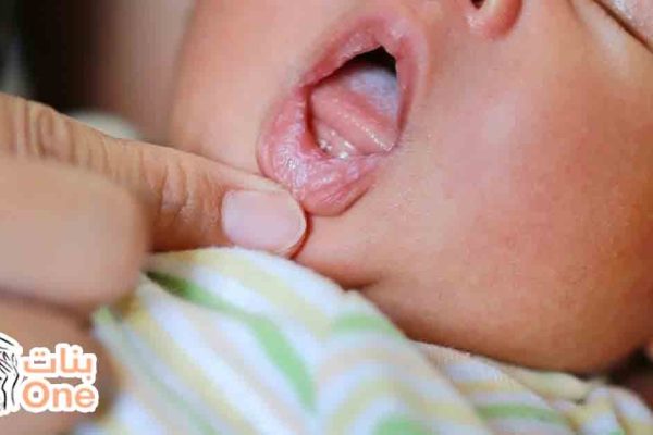 فطريات الفم عند الرضع أسبابها وعلاجها  