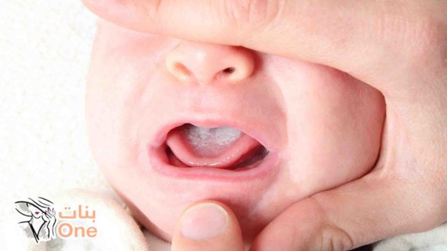 فطريات الفم عند الرضع أسبابها وعلاجها  