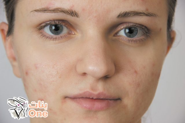 سبب ظهور الدمامل في الوجه  