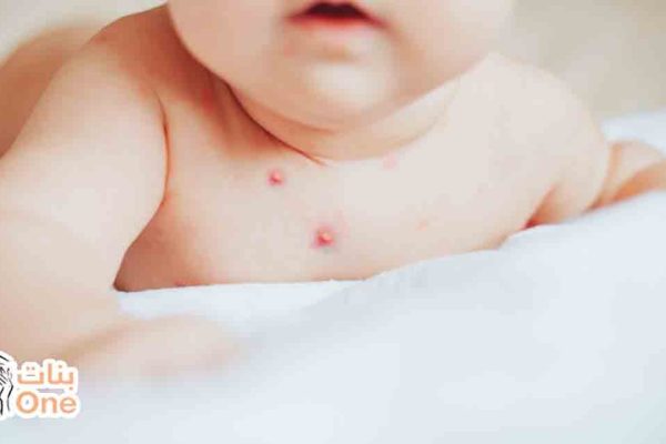 أسباب ظهور حبوب حمراء في جسم الأطفال  