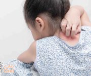ما أسباب الإكزيما عند الأطفال  