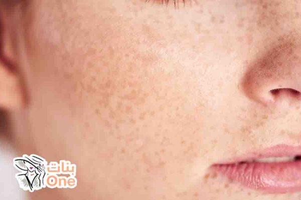 وصفات لإزالة البقع السوداء من الوجه  