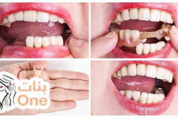 الفرق بين زراعة الأسنان وتركيب الأسنان  