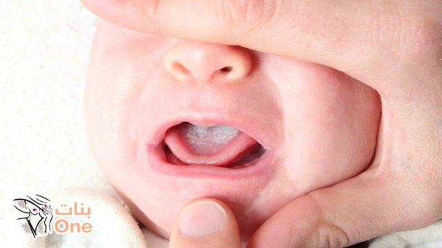 أسباب الفطريات عند الرضع وطرق علاجها  