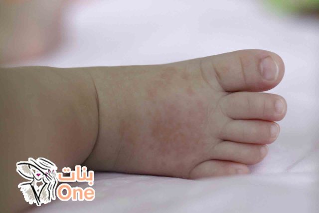 علاج الطفح الجلدي عند الرضع  