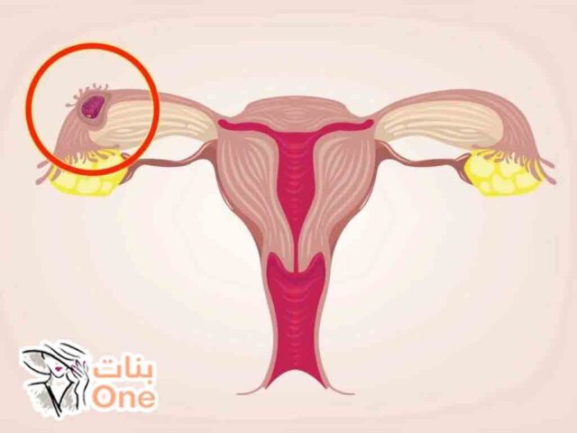 ما هو الحمل خارج الرحم؟  
