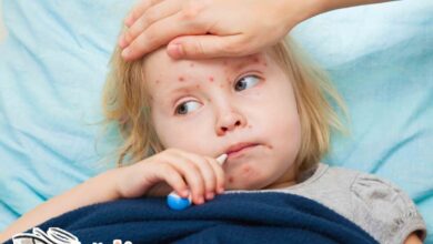ما هي أعراض الحصبة عند الأطفال  