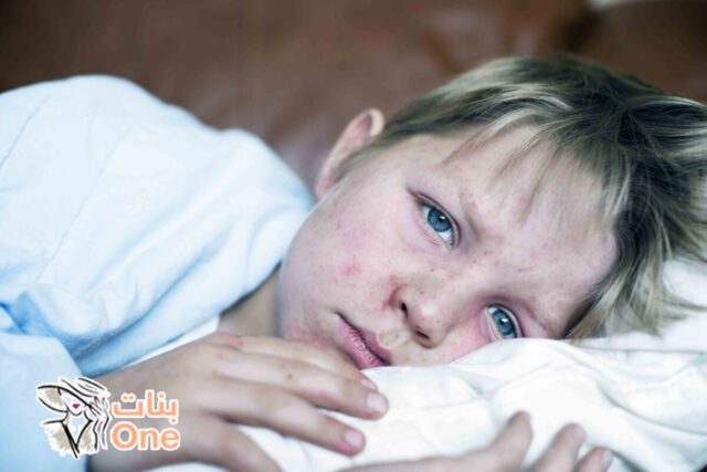 ما هي أعراض الحصبة عند الأطفال  