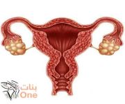 أضرار بطانة الرحم المهاجرة على الجسم والحمل  