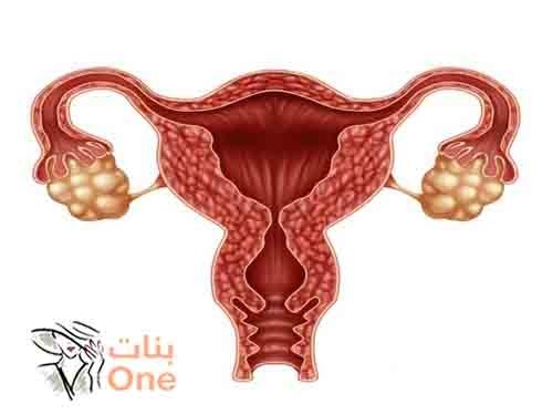 أضرار بطانة الرحم المهاجرة على الجسم والحمل  
