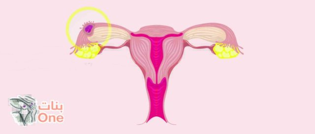 ماهي اعراض الحمل خارج الرحم  