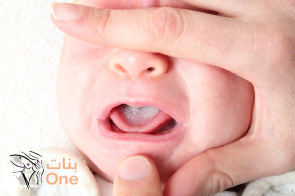طرق علاج الفطريات في لسان الرضيع وكيفية الوقاية منها  