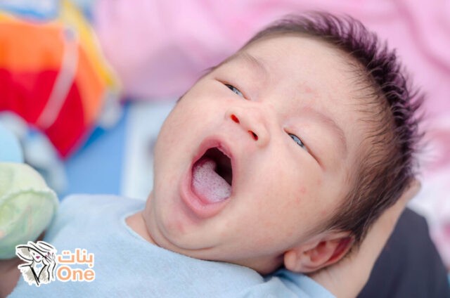 طرق علاج الفطريات في لسان الرضيع وكيفية الوقاية منها  
