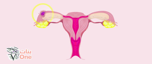 ما هي أعراض الحمل خارج الرحم  
