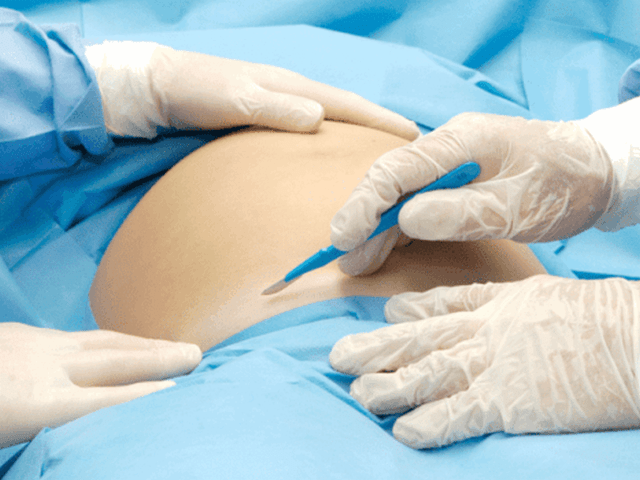 ما هي أضرار الولادة القيصرية  
