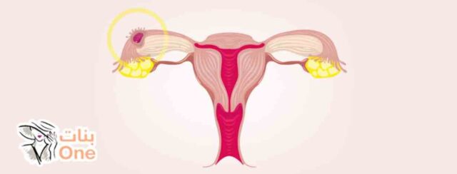 ما هو الحمل خارج الرحم وأعراضه  